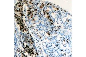 Immunohistochemical analysis of TFIIF RAP 30 staining in human colon cancer formalin fixed paraffin embedded tissue section. (GTF2F2 Antikörper)