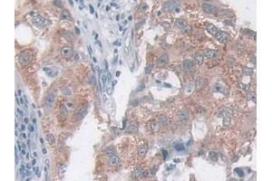 IHC-P analysis of Human Breast cancer Tissue, with DAB staining. (CCL20 Antikörper  (AA 27-96))