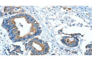 Immunohistochemistry of paraffin-embedded Human colon cancer using GLRA1 Polyclonal Antibody at dilution of 1:30 (GLRA1 Antikörper)