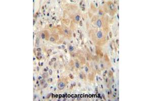 NR0B2 antibody (Center) immunohistochemistry analysis in formalin fixed and paraffin embedded human hepatocarcinoma followed by peroxidase conjugation of the secondary antibody and DAB staining. (NR0B2 Antikörper  (Middle Region))