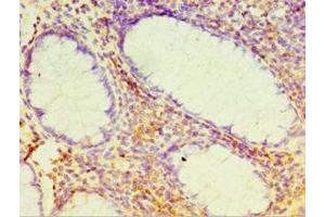 Immunohistochemistry of paraffin-embedded human colon cancer using ABIN7164384 at dilution of 1:100 (DHX58 Antikörper  (AA 389-678))