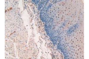 IHC-P analysis of Human Esophagus Cancer Tissue, with DAB staining. (SP100 Antikörper  (AA 610-802))