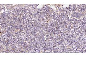 ABIN6273171 at 1/100 staining Human lymph cancer tissue by IHC-P. (STT3B Antikörper  (C-Term))
