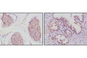Immunohistochemical analysis of paraffin-embedded human human testis (left) and prostate cancer (right) tissues using Androgen Receptor mouse mAb with DAB staining.