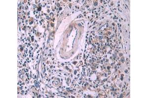 Used in DAB staining on fromalin fixed paraffin- embedded stomach cancer tissue