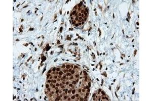 Immunohistochemical staining of paraffin-embedded Adenocarcinoma of colon tissue using anti-LTA4H mouse monoclonal antibody.