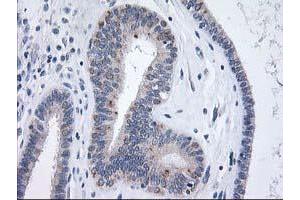 Immunohistochemical staining of paraffin-embedded Adenocarcinoma of Human endometrium tissue using anti-XPNPEP3 mouse monoclonal antibody. (XPNPEP3 Antikörper)