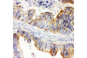 Immunohistochemistry (IHC) image for anti-Hypoxia Inducible Factor 1, alpha Subunit (Basic Helix-Loop-Helix Transcription Factor) (HIF1A) (AA 703-732) antibody (ABIN3028724)