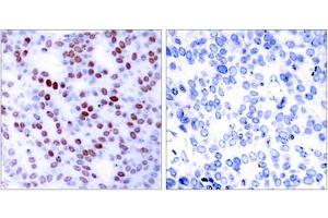 Immunohistochemical analysis of paraffin-embedded human breast carcinoma tissue, using c-Jun (epitope around residue 243) antibody (ABIN5976223). (C-JUN Antikörper  (Ser243))