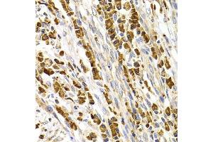 Immunohistochemistry of paraffin-embedded human stomach cancer using TACR3 antibody. (TACR3 Antikörper  (AA 356-465))