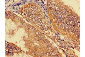 Immunohistochemistry of paraffin-embedded human endometrial cancer using ABIN7170144 at dilution of 1:100 (SLC22A2 Antikörper  (AA 48-135))