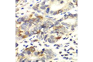 Immunohistochemistry of paraffin-embedded human colon carcinoma using APLP1 antibody at dilution of 1:100 (x40 lens). (APLP1 Antikörper)