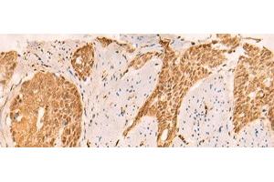 Immunohistochemistry of paraffin-embedded Human esophagus cancer tissue using SETD1A Polyclonal Antibody at dilution of 1:25(x200) (SETD1A Antikörper)