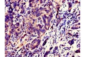 Immunohistochemistry of paraffin-embedded human pancreatic cancer using ABIN7170444 at dilution of 1:100 (C21ORF56 Antikörper  (AA 1-186))