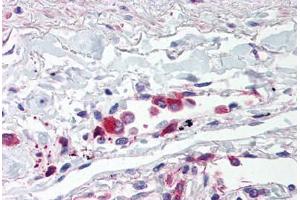 Human Lung, Alveolar Macrophages (formalin-fixed, paraffin-embedded) stained with TLR5 antibody ABIN214528 at 5 ug/ml followed by biotinylated goat anti-rabbit IgG secondary antibody ABIN481713, alkaline phosphatase-streptavidin and chromogen. (TLR5 Antikörper  (Internal Region))