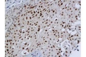 Formalin-fixed and paraffin embedded human bladder cancer labeled with Anti-DBC1/DELETED IN BLADDER CANCER 1 Polyclonal Antibody, Unconjugated (ABIN680308) followed by conjugation to the secondary antibody and DAB staining (DBC1 Antikörper  (AA 101-200))