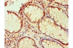 Immunohistochemical of paraffin-embedded human colon cancer using ABIN7176818 at dilution of 1:200. (PLA2G7 Antikörper)