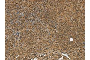 The image on the left is immunohistochemistry of paraffin-embedded Human ovarian cancer tissue using ABIN7192784(TGM7 Antibody) at dilution 1/30, on the right is treated with synthetic peptide. (Transglutaminase 7 Antikörper)
