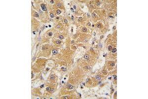 Formalin-fixed and paraffin-embedded human hepatocarcinoma tissue reacted with OA5 antibody (N-term) 7412a , which was peroxidase-conjugated to the secondary antibody, followed by DAB staining. (APOA5 Antikörper  (N-Term))