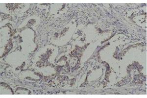 Immunohistochemistry of paraffin-embedded Human breast carcinoma tissue with Phosphotyrosine Monoclonal Antibody at dilution of 1:200 (Phosphotyrosine Antikörper)