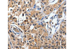 Immunohistochemistry of Human lung cancer using DUSP8 Polyclonal Antibody at dilution of 1:40 (DUSP8 Antikörper)