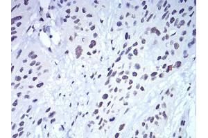 Immunohistochemical analysis of paraffin-embedded esophageal cancer tissues using CBX5 mouse mAb with DAB staining. (CBX5 Antikörper  (AA 1-191))
