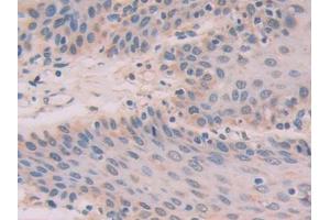 DAB staining on IHC-P; Samples: Human Stomach cancer Tissue (IL-33 Antikörper  (AA 1-270))