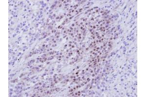 IHC-P Image Immunohistochemical analysis of paraffin-embedded SAS Xenograft , using RBMY1A1, antibody at 1:100 dilution. (RBMY1A1 Antikörper)