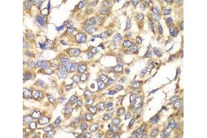 Immunohistochemistry of paraffin-embedded Human esophageal cancer using VTI1B Polyclonal Antibody at dilution of 1:100 (40x lens). (VTI1B Antikörper)