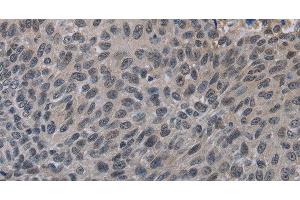 Immunohistochemistry of paraffin-embedded Human lung cancer tissue using TP53AIP1 Polyclonal Antibody at dilution 1:50