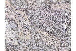 ABIN7096400 and ABIN7100464 at 1/100 staining human lung cancer by IHC-P. (PRAM1 Antikörper)