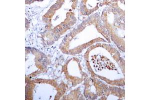 Immunohistochemical analysis of Aldose Reductase staining in human colon cancer formalin fixed paraffin embedded tissue section. (AKR1B1 Antikörper  (C-Term))