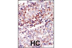 Formalin-fixed and paraffin-embedded human cancer tissue reacted with the primary antibody, which was peroxidase-conjugated to the secondary antibody, followed by AEC staining. (TEK Antikörper  (C-Term))