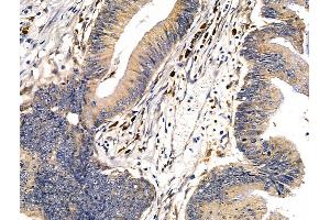 ABIN7094682 and ABIN7098733 at 1/100 staining Human colorectal cancer by IHC-P.