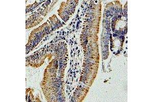 Immunohistochemical analysis of GNAI3 staining in human colon cancer formalin fixed paraffin embedded tissue section. (GNAI3 Antikörper)