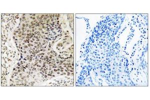 Immunohistochemistry analysis of paraffin-embedded human lung carcinoma tissue, using TSEN54 antibody. (TSEN54 Antikörper  (Internal Region))