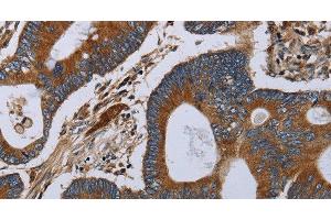 Immunohistochemistry of paraffin-embedded Human colon cancer tissue using MT-ND6 Polyclonal Antibody at dilution 1:40 (MT-ND6 Antikörper)