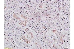 Formalin-fixed and paraffin-embedded human lung carcinoma tissue labeled with Rabbit Anti-IGF1R/CD221 Polyclonal Antibody, Unconjugated  at 1:300 followed by conjugation to the secondary antibody and DAB staining (IGF1R Antikörper  (AA 251-350))