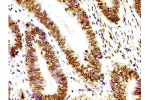 IHC image of ABIN7127295 diluted at 1:100 and staining in paraffin-embedded human colon cancer performed on a Leica BondTM system. (Rekombinanter HIST1H3A Antikörper)