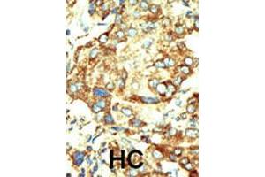 Formalin-fixed and paraffin-embedded human hepatocellular carcinoma tissue reacted with the primary antibody, which was peroxidase-conjugated to the secondary antibody, followed by DAB staining. (Dnmt2 Antikörper  (AA 353-383))