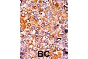 Formalin-fixed and paraffin-embedded human cancer tissue reacted with PKMYT1 (phospho T495) polyclonal antibody  which was peroxidase-conjugated to the secondary antibody followed by AEC staining. (PKMYT1 Antikörper  (pThr495))