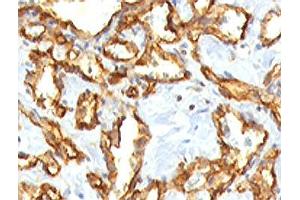 IHC staining of FFPE human angiocarcinoma with CD31 antibody.