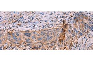 Immunohistochemistry of paraffin-embedded Human cervical cancer tissue using KBTBD11 Polyclonal Antibody at dilution of 1:35(x200) (KBTBD11 Antikörper)