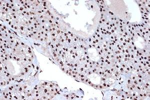 Immunohistochemistry of paraffin-embedded human liver cancer using macroH2A. (H2AFY Antikörper)