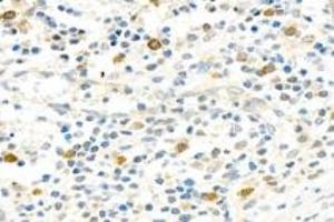 Immunohistochemistry analysis of paraffin-embedded human appendix using,PARP1 (ABIN7075114) at dilution of 1: 750 (PARP1 Antikörper  (cleaved))