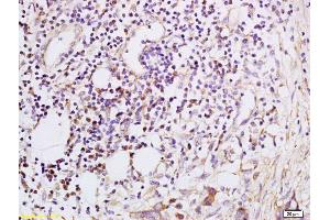 Formalin-fixed and paraffin embedded Human esophageal carcinoma labeled with Anti-CXCL5 Polyclonal Antibody, Unconjugated (ABIN741900) at 1:200, followed by conjugation to the secondary antibody and DAB staining (CXCL5 Antikörper  (AA 51-132))