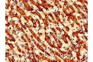 Immunohistochemistry of paraffin-embedded human liver cancer using ABIN7149659 at dilution of 1:100
