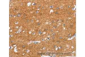 Immunohistochemistry of Human thyroid cancer using SNCA Polyclonal Antibody at dilution of 1:30 (SNCA Antikörper)
