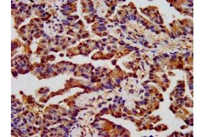 IHC image of ABIN7161356 diluted at 1:400 and staining in paraffin-embedded human lung cancer performed on a Leica BondTM system. (CHRNB3 Antikörper  (AA 67-218))