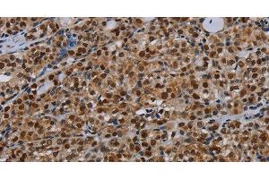 Immunohistochemistry of paraffin-embedded Human thyroid cancer tissue using DCAF6 Polyclonal Antibody at dilution 1:30 (DCAF6 Antikörper)